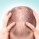 Hair Loss Treatment